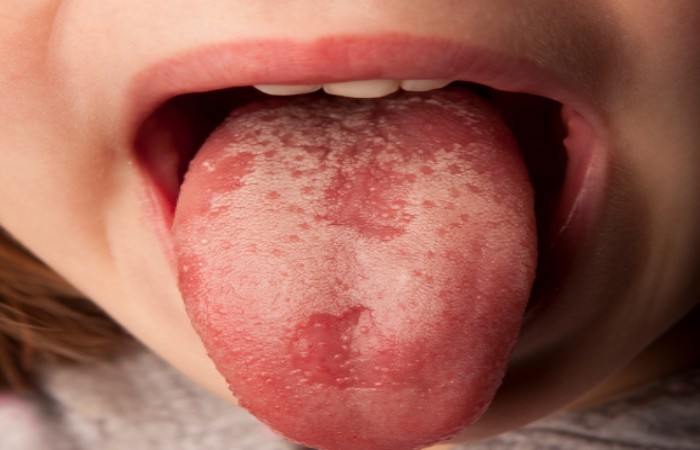 Health of Tongue Signs and Symptoms